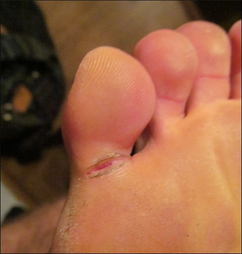 cracked little toe 