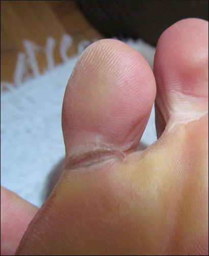 cracked toe 3(cropped+scaled)