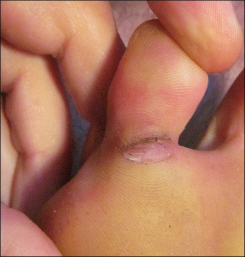 cracked toe 4(cropped+scaled)