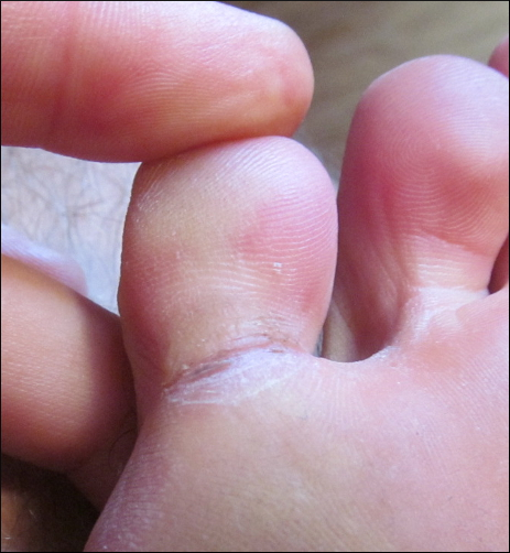 cracked toe 5(cropped+scaled)